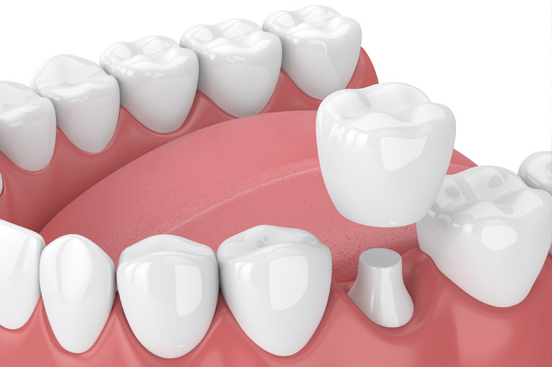 Dental Crowns in Leander