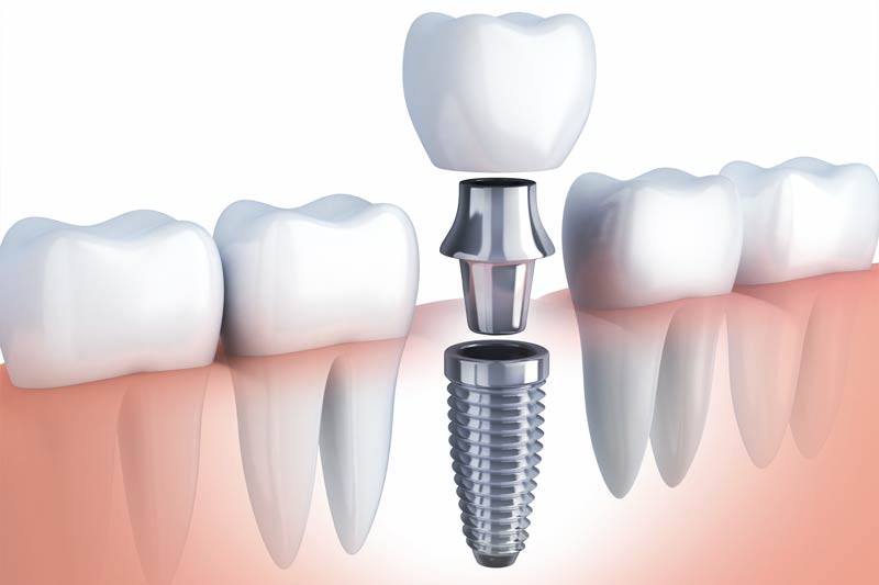 Implants Dentist in Leander
