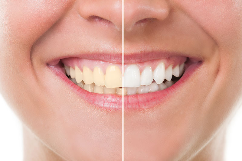 Teeth Whitening in Leander