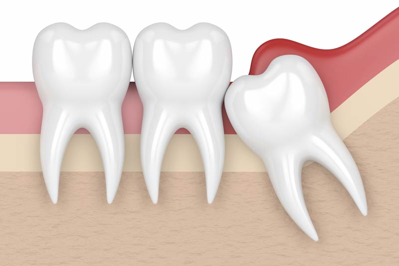 Wisdom Tooth Removal in Leander