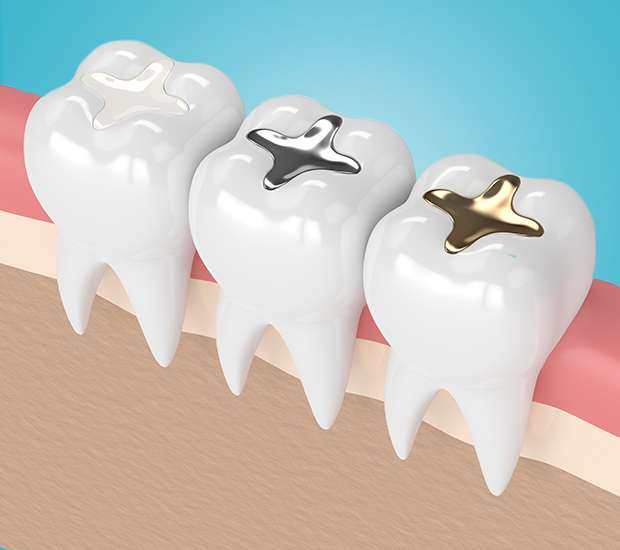 Leander Composite Fillings