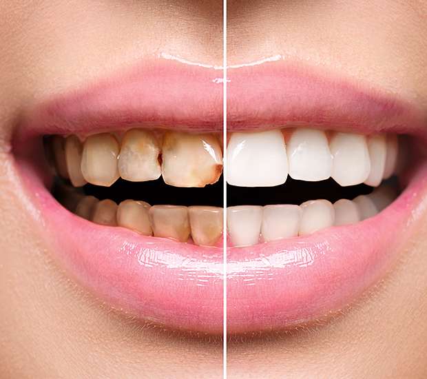 Leander Dental Implant Restoration