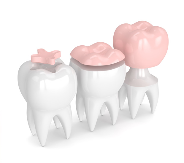 Leander Dental Inlays and Onlays