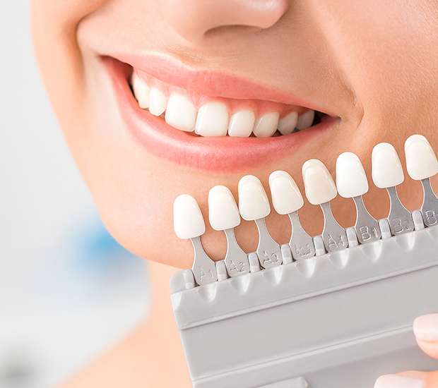 Leander Dental Veneers and Dental Laminates