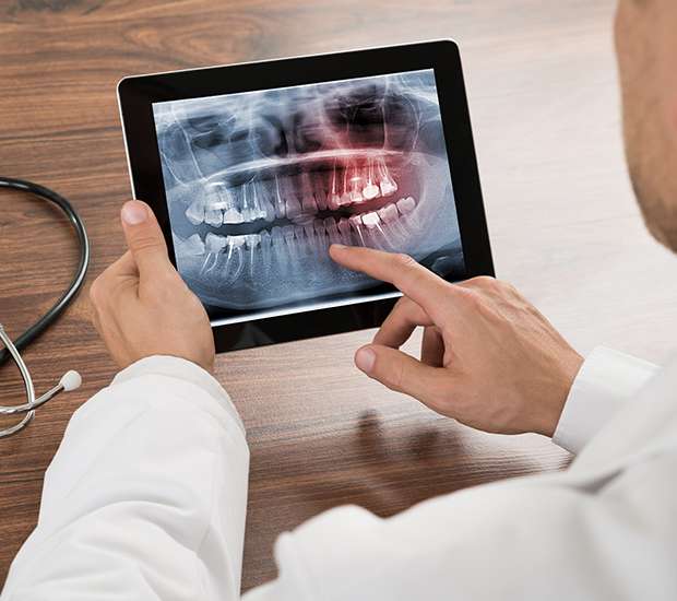 Leander Types of Dental Root Fractures