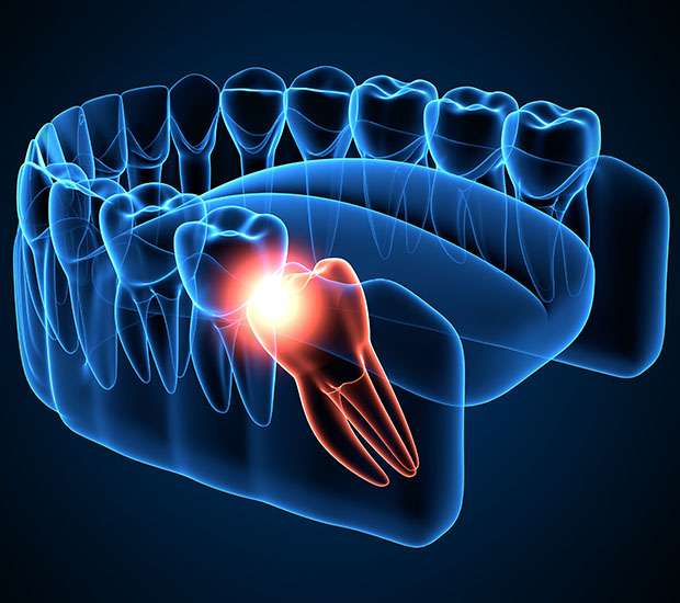 Leander Wisdom Teeth Extraction